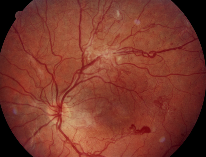 Diabetische Retinopathie