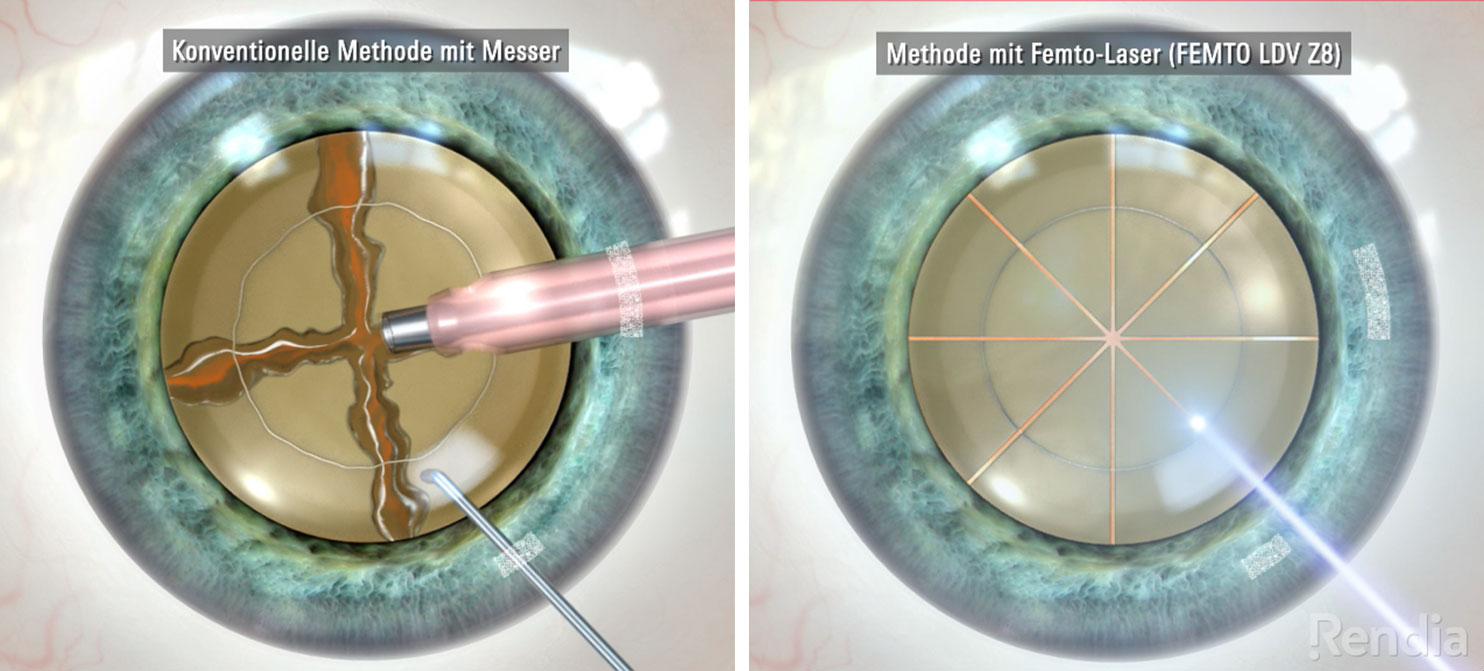 Grauer Star OP: Vergleich: Zerkleinerung des Linsenkerns bei konventioneller OP und Laser-OP